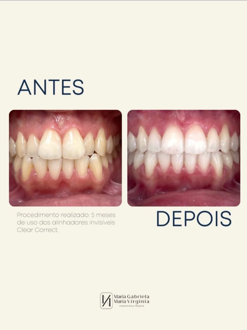 Transformação de sorriso antes e depois - Odontologia Premium em Limeira-SP