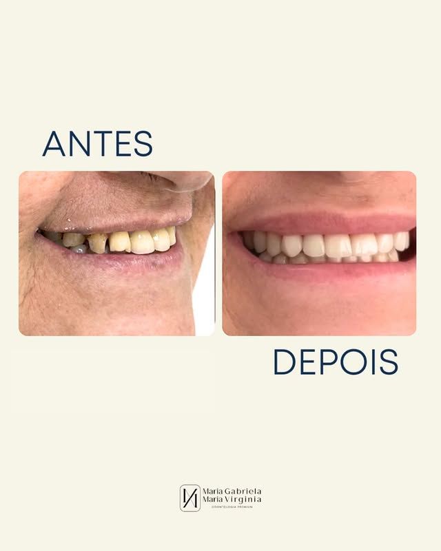 Transformação de sorriso antes e depois - Odontologia Premium em Limeira-SP