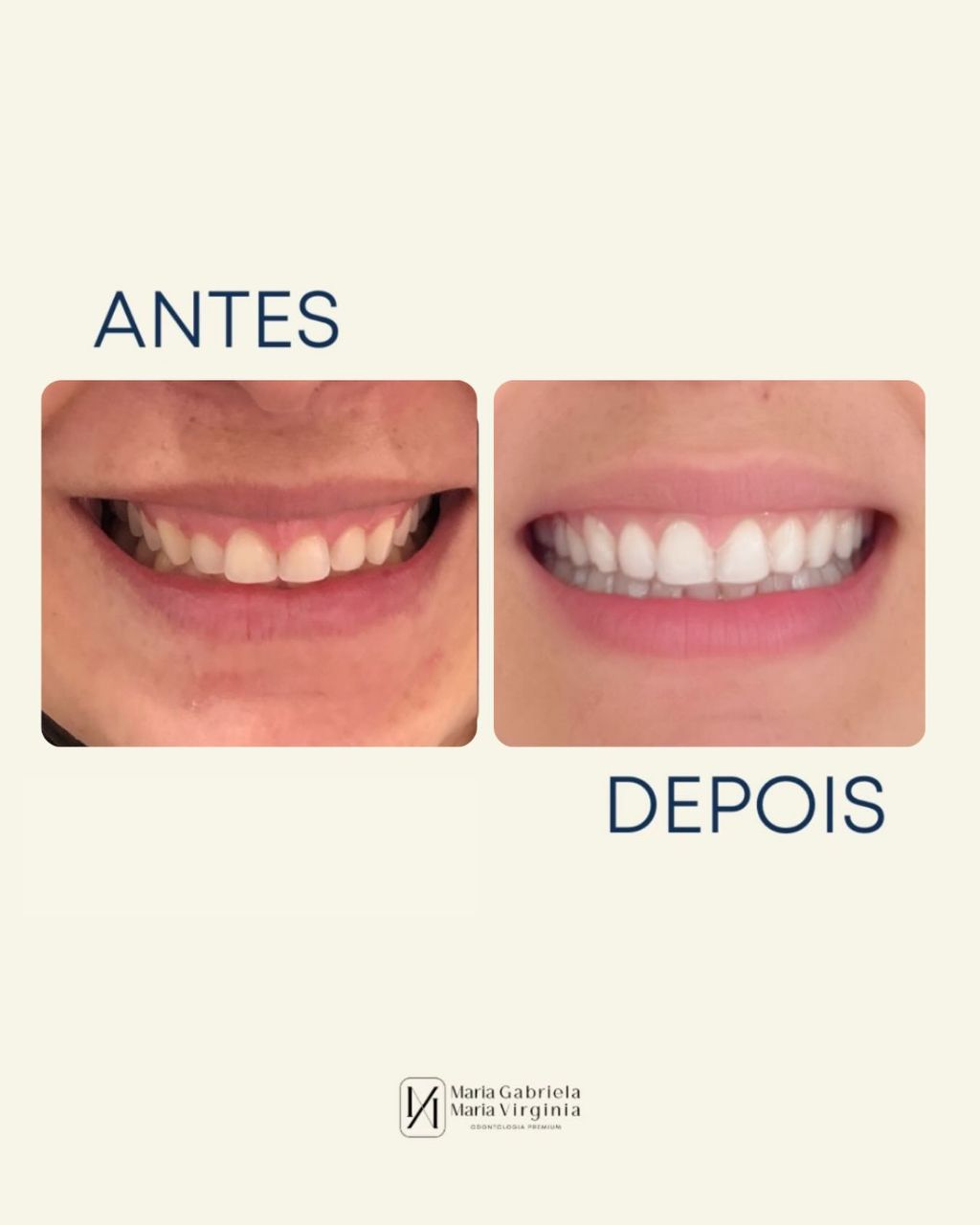 Transformação de sorriso antes e depois - Odontologia Premium em Limeira-SP