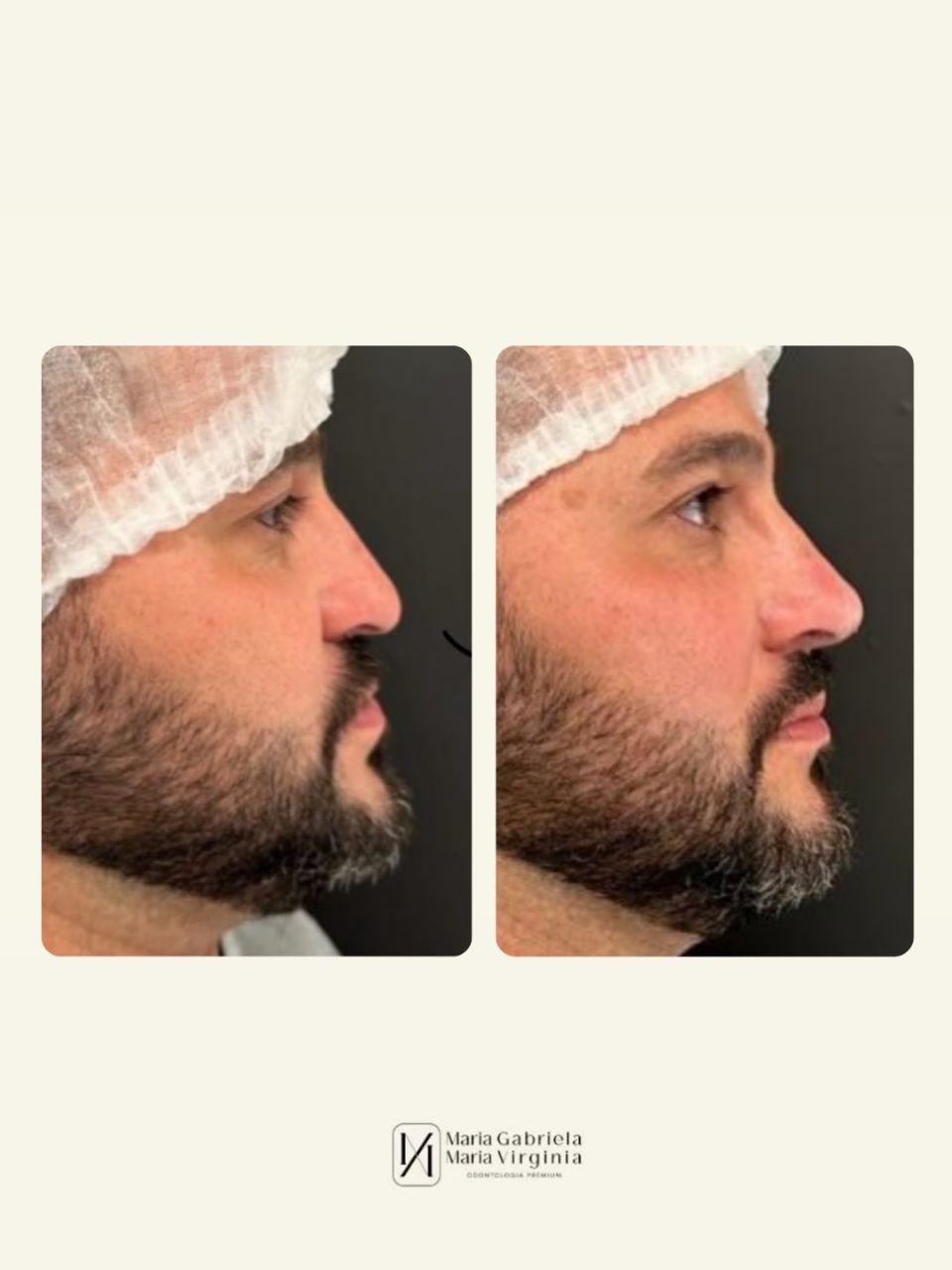 Transformação de sorriso antes e depois - Odontologia Premium em Limeira-SP